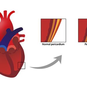 دلایل بروز پریکاردیت قلبی