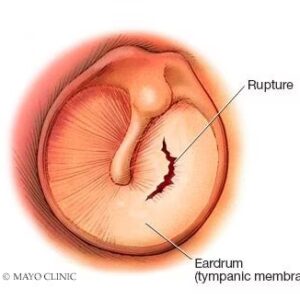 دلایل پارگی پرده گوش
