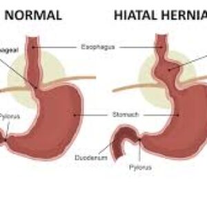 آنچه در مورد فتق هیتال باید بدانید